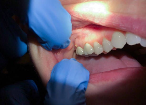 Best Broken or Chipped Tooth Repair in Yadkinville, NC